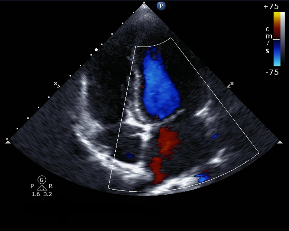 Doppler echocardiogram